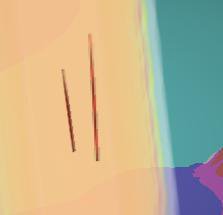[TW self-harm] Rubbing them again
